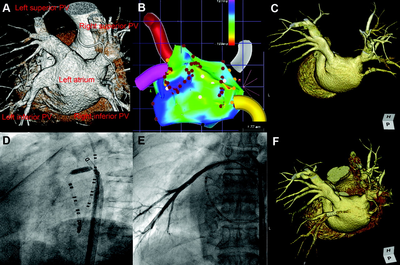 ablation